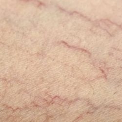 Aplicação de Telangiectasias (Vasinhos)