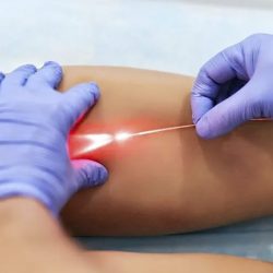 Mini Cirurgia de Varizes a Laser